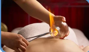 Fire Cupping - Famous Cupping Clinic near by me